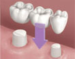dental bridge - colgate au