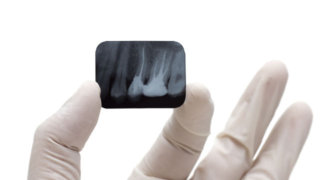 Hand holding a teeth x-ray